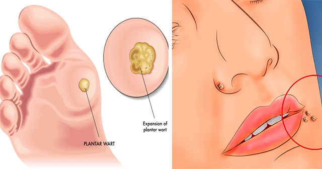 Remove Warts With These Easy and Natural Remedies.